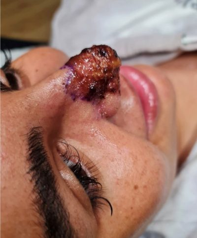 image002 1 Un produit de comblement raté a failli faire perdre à une femme son nez et sa bouche à cause d'un insecte mangeur de chair.