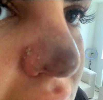 image005 Un produit de comblement raté a failli faire perdre à une femme son nez et sa bouche à cause d'un insecte mangeur de chair.